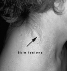 PXE Skin Lesion
